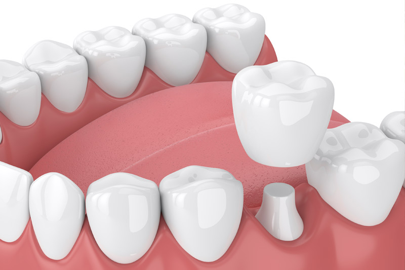 Dental Crowns in Slidell