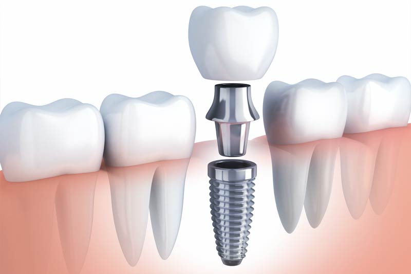 Implants Dentist in Slidell